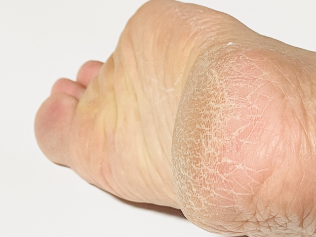 草加・八潮・越谷・足立区周辺で看護師フットケアならりふぁいん鍼灸整骨院
足・かかとのかさかさ