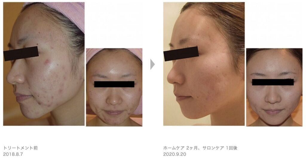 症例写真1
草加・八潮・越谷・足立区でピーリング・美容エステならりふぁいん鍼灸整骨院