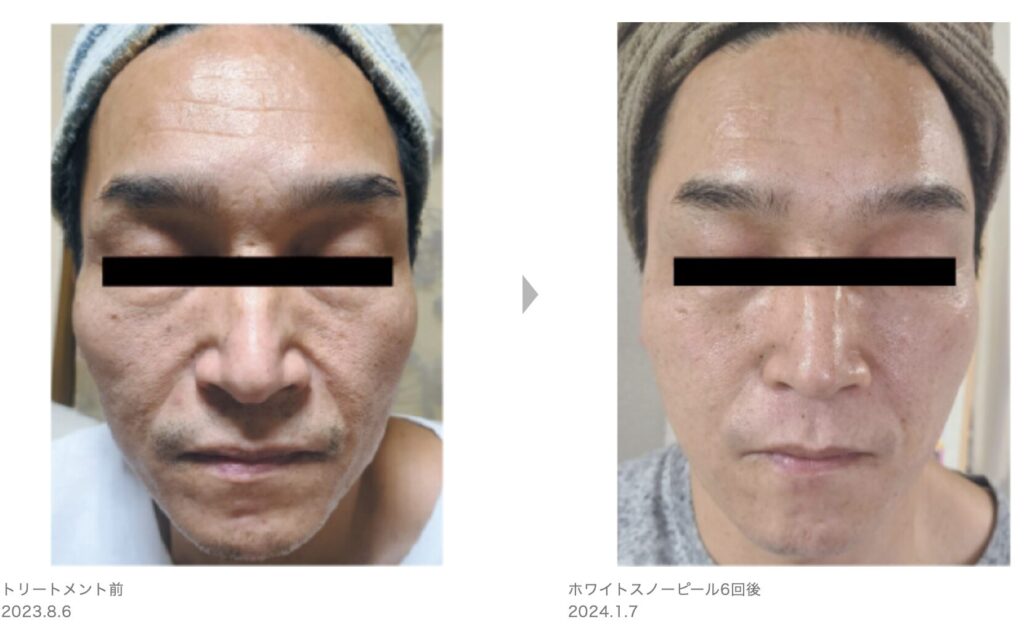 症例写真3
草加・八潮・越谷・足立区でピーリング・美容エステならりふぁいん鍼灸整骨院