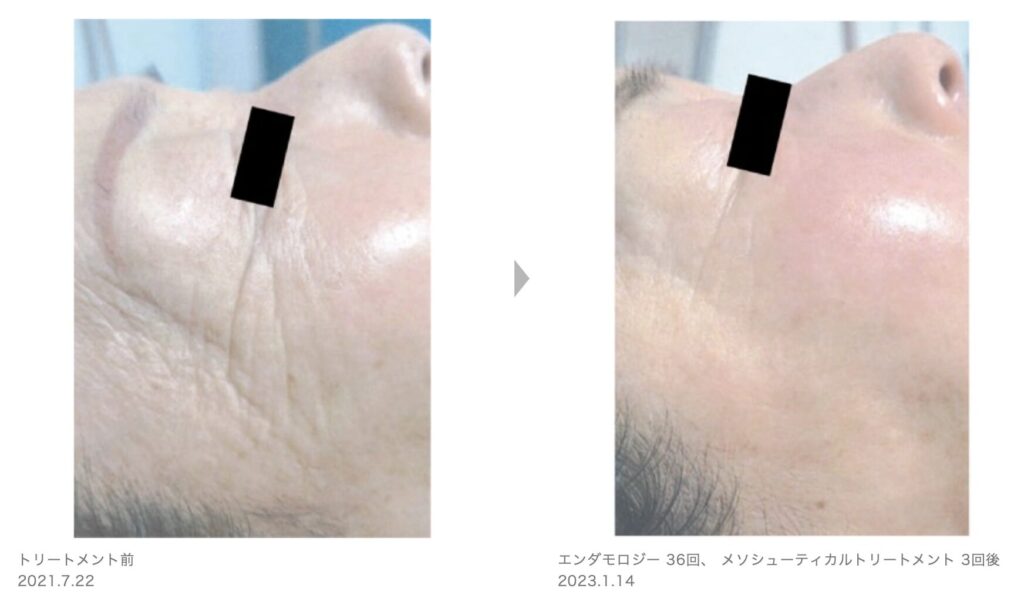 症例写真4
草加・八潮・越谷・足立区でピーリング・美容エステならりふぁいん鍼灸整骨院