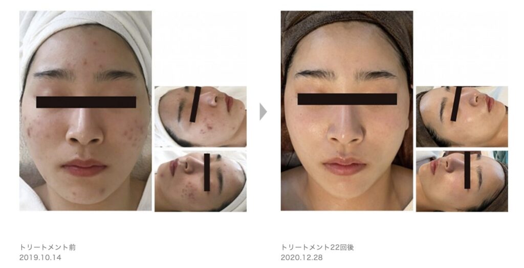 症例写真2
草加・八潮・越谷・足立区でピーリング・美容エステならりふぁいん鍼灸整骨院