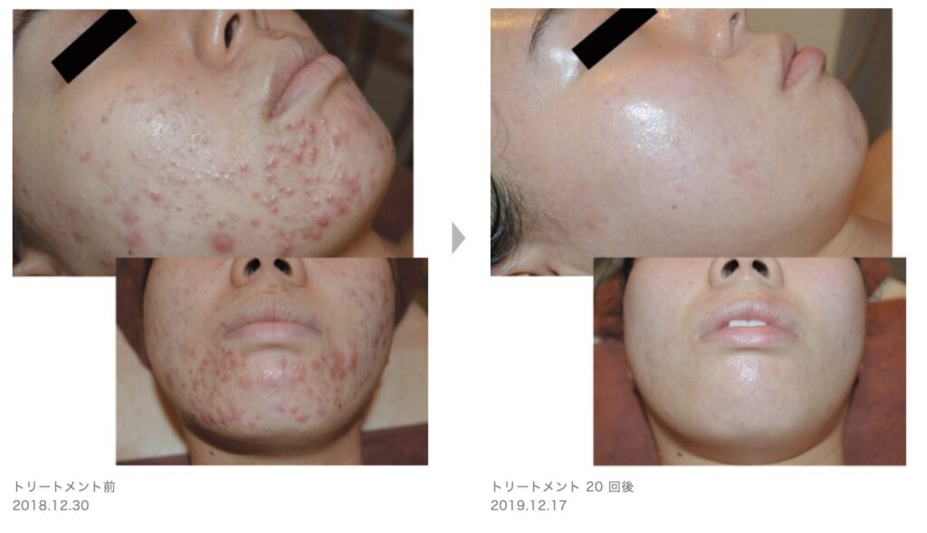 症例写真5
草加・八潮・越谷・足立区でピーリング・美容エステならりふぁいん鍼灸整骨院