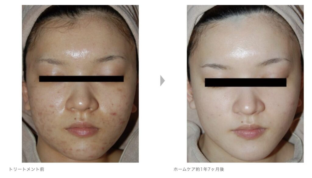 症例写真6
草加・八潮・越谷・足立区でピーリング・美容エステならりふぁいん鍼灸整骨院